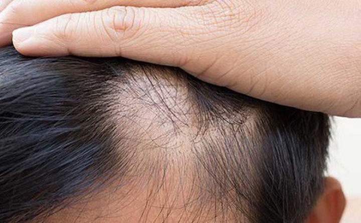 Hói đầu ở nam giới có liên quan đến vấn đề sinh lý?  - đầu tiên