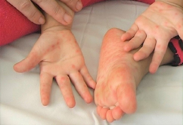 Bé trai 1 tuổi ở Đắk Lắk tử vong vì bệnh tay chân miệng - 1