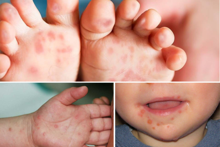 TP.HCM: Bé 5 tuổi tử vong nghi do bệnh tay chân miệng - 1