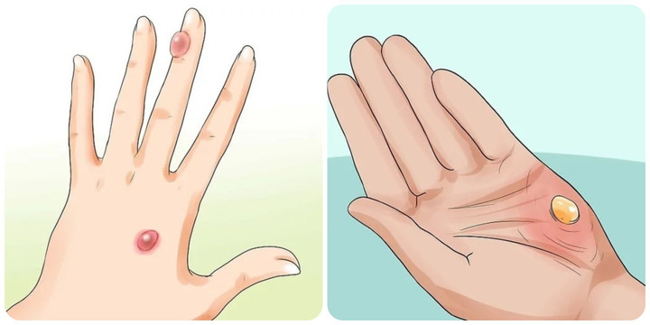 Cách chữa vết bỏng bị phồng rộp hết rát và nhanh lành - 1