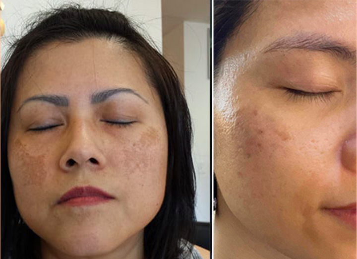 Bộ 3 sản phẩm Hi Beauty hỗ trợ mờ nám, sáng da, trả lại nét đẹp thanh xuân - 1
