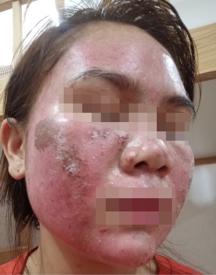 Mặt bỏng rát, bong tróc như da rắn sau khi bôi thuốc tại spa - 1