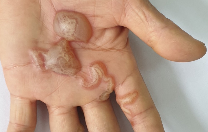 Giun đũa chó mèo 'đào hầm' trong da từ thói quen nhiều người vẫn làm hàng ngày - 1