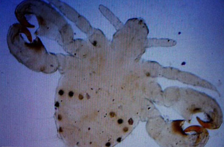 Bắt gần 100 con rận mu làm tổ trên mắt bé trai 5 tuổi - 1