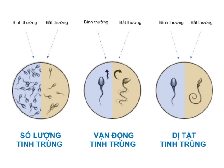 3 yếu tố căn bản đánh giá chất lượng tinh trùng.