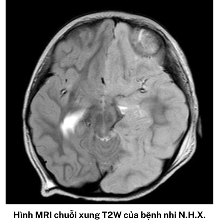 HEE là một bệnh hiếm gặp, có trạng thái co giật nửa người kéo dài trên trẻ sốt dưới 4 tuổi, gây liệt nửa người cùng bên co giật và teo não bán cầu đối bên. (Ảnh: BVCC)