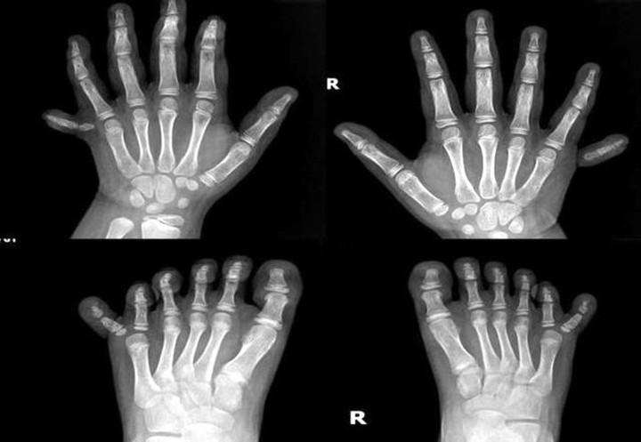 Hình ảnh chụp X-quang bàn tay và chân cháu T.L. (Ảnh: Bệnh viện cung cấp)