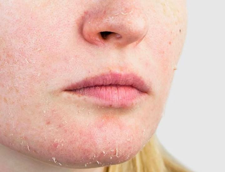 Da bị khô khi các lipid tự nhiên trong da mất đi, hàng rào bảo vệ bề mặt da bị tổn thương, mất khả năng giữ ẩm.