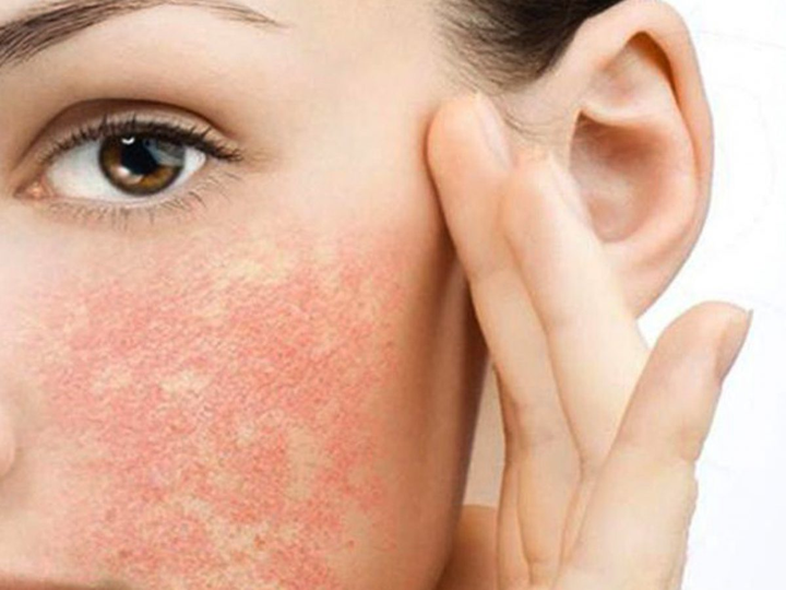 Cách nhận biết da nhạy cảm: Da bị ửng đỏ là một dấu hiệu.