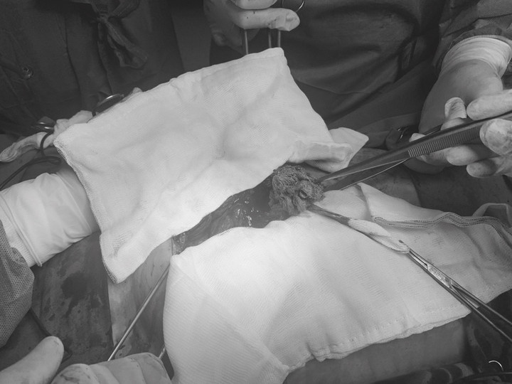 Phẫu thuật cấp cứu lấy gạc trong ổ bụng người bệnh tại Bệnh viện Đa khoa Tâm Anh.