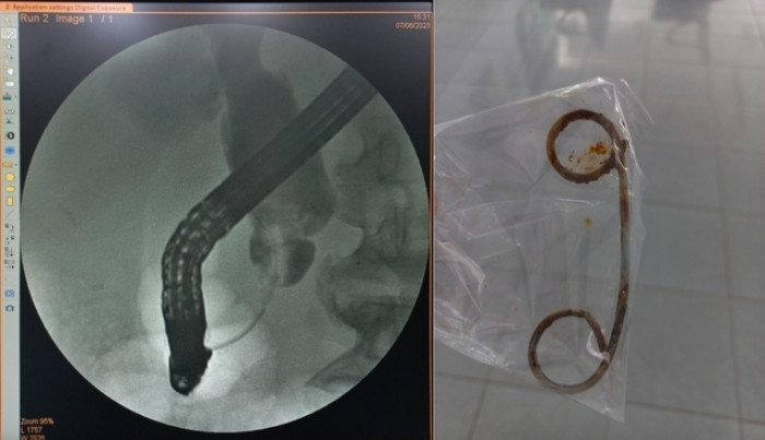Ảnh chụp đường mật bị hẹp đoạn cuối ống mật chủ và stent bị tắc do để quá lâu. (Ảnh: BVCC)