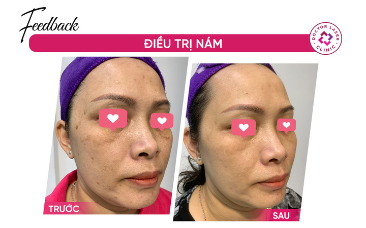Hình ảnh phản hồi từ khách hàng sau liệu trình điều trị nám tại Doctor Laser.