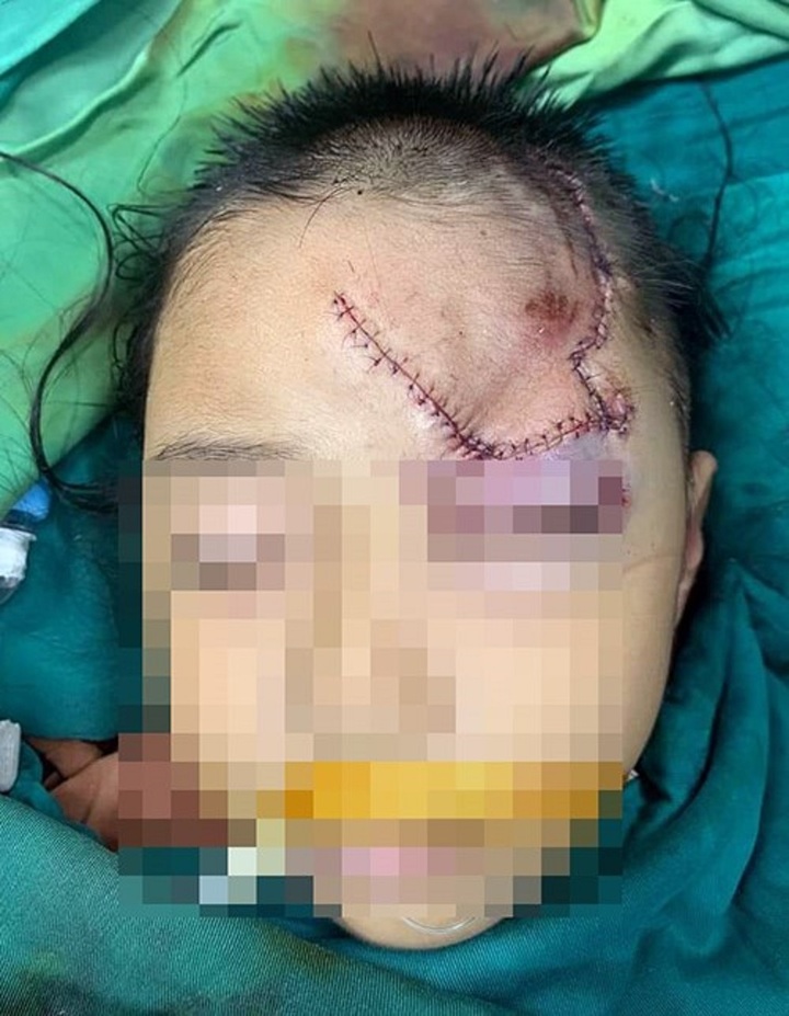 Ngồi chơi trước cửa, bé trai 5 tuổi ở Nghệ An bị chó lạ cào cắn vào mặt - 1