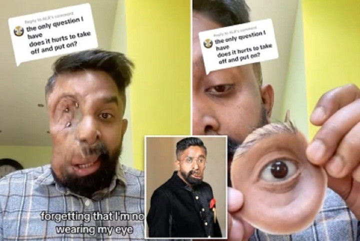 Câu chuyện xúc động đằng sau đôi mắt giả kỳ lạ của người đàn ông Anh - 2