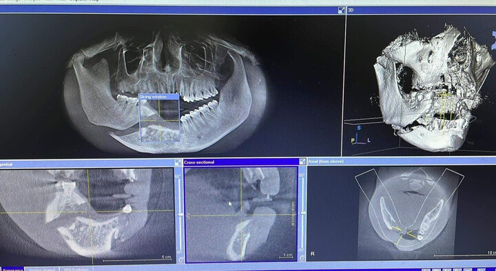 Mất toàn bộ răng cửa vì cúi người vào thang máy đang sửa để nhặt điện thoại - 1