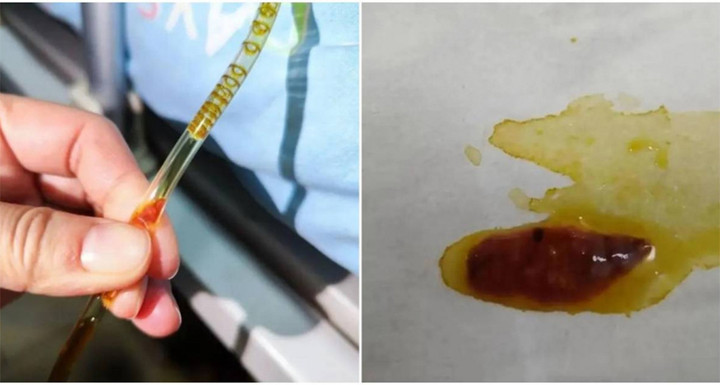 Những con sán lá gan bò trong ống dẫn lưu của bệnh nhân.