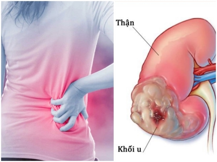 9. Nghiên Cứu Mới Về Ung Thư Thận