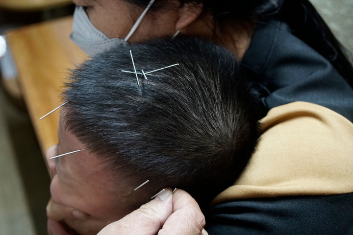 Mỗi bé được châm 25 kim tại các vùng trên đầu. (Ảnh: Nguyễn Ngoan)