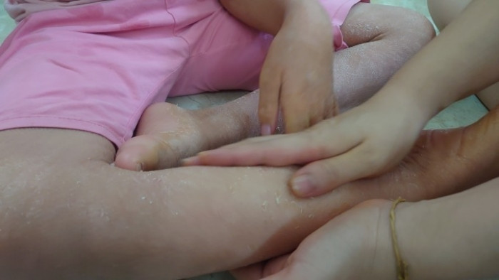 Bệnh vảy cá khiến da khô, bong tróc. (Ảnh: GĐCC)