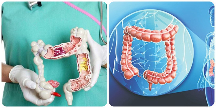 Ung thư đại tràng là căn bệnh ung thư gây tử vong cao thứ 4 trên thế giới
