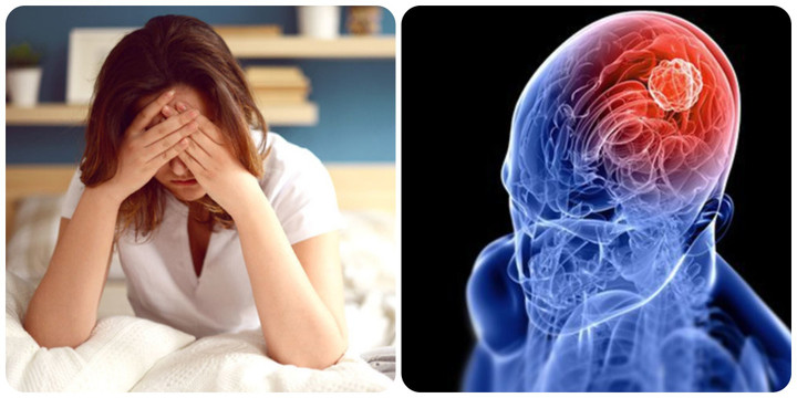 Các bác sĩ cho biết các khối u não gây ra những cơn đau đầu rất đặc trưng thường nặng hơn vào buổi sáng.