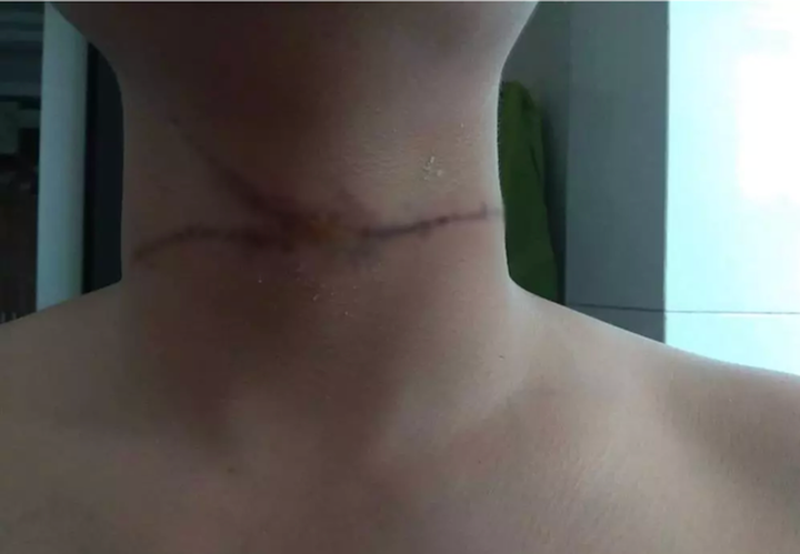 Anh Đ. bị dây diều cứa vào cổ khi đang điều khiển xe máy trên đường.