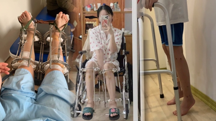 Sau phẫu thuật chân Hyanna được cố định bằng khung xương kim loại, phải tập đi như trẻ em.