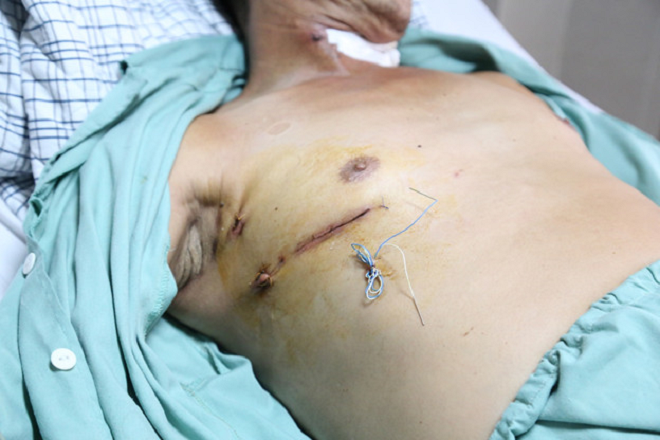 Vết mổ nhỏ khoảng 4cm.