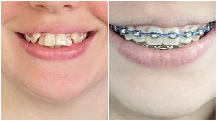 Đây là kết quả sau 260 ngày đeo niềng răng. (Ảnh: NunchiDreamer/Reddit)