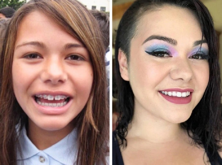 Hàm răng đã làm thay đổi khuôn mặt của cô gái. (Ảnh: Queenwavvvy/Reddit)