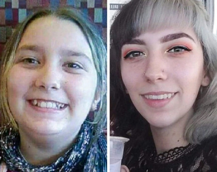 Cô nàng này đã phải trải qua 5 năm niềng răng. (Ảnh: Katlime0 / Reddit)