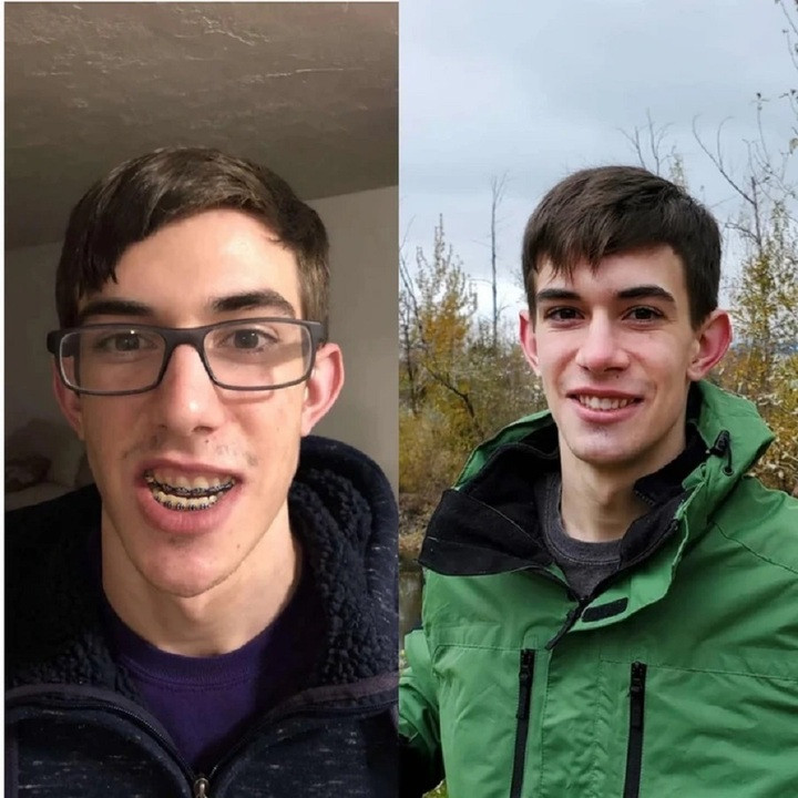 Để có diện mạo điển trai, người đàn ông này đã phẫu thuật cắt hàm và niềng răng. (Ảnh: Bradtheballer12/Reddit)