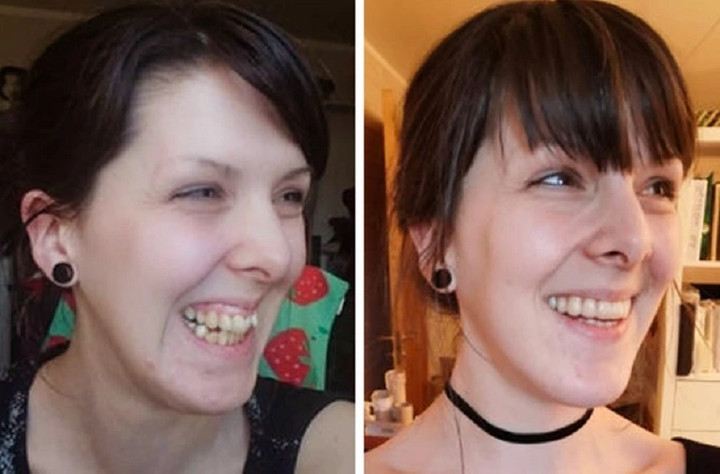 Để có một hàm răng đều đẹp, người phụ nữ này phải chịu đựng hơn 2 năm niềng răng, 1 lần nhổ răng khôn và 2 lần phẫu thuật chỉnh hàm. (Ảnh: Cupcakezz/Reddit)