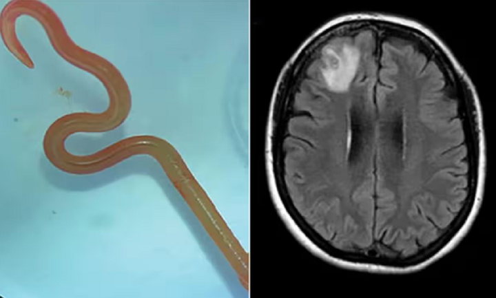 Cận cảnh con giun và vùng não thể hiện tình trạng bất thường ở bệnh nhân.