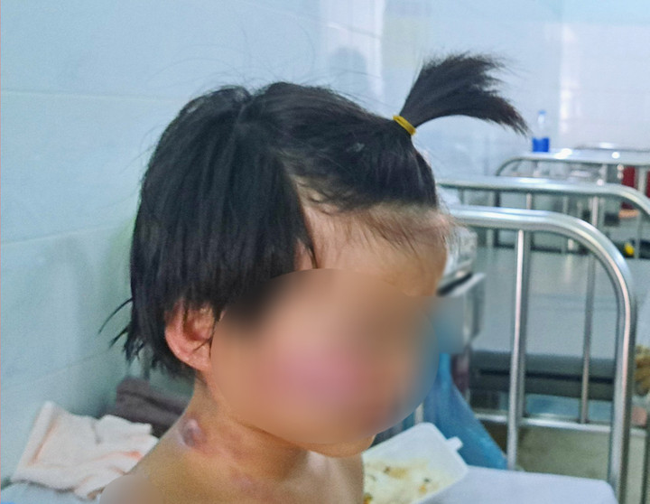 Các bệnh nhân đang được điều trị tại Bệnh viện Nhi Đồng 2, TP.HCM.