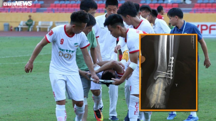 Dương Văn Hào chấn thương nặng suýt phải giải nghệ. (Ảnh: Trường Giang)