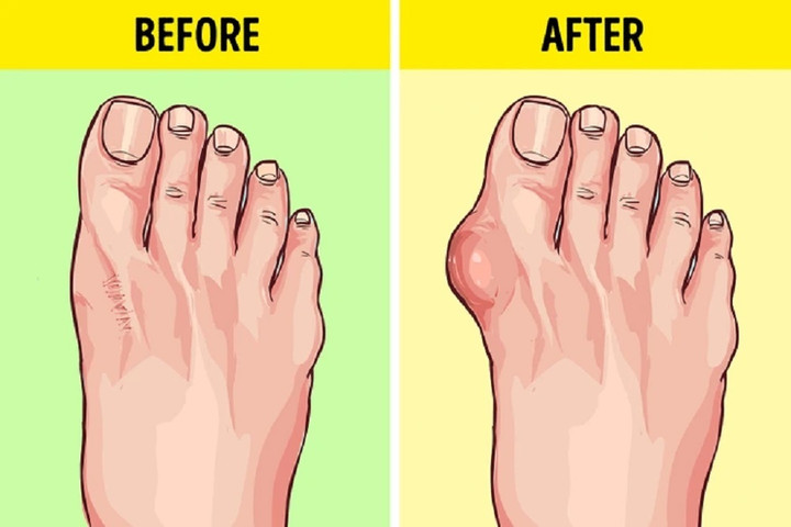 Một trong những tác hại khi thường xuyên đi dép xỏ ngón là nguy cơ viêm gân.