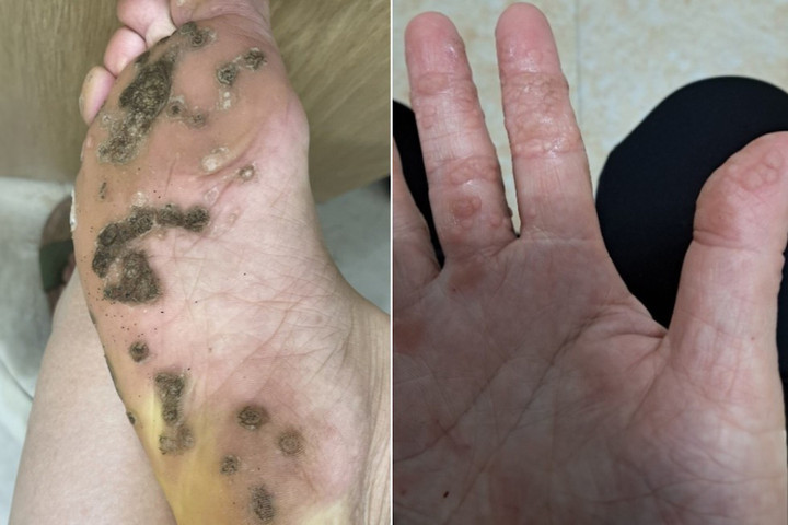 Chân tay người đàn ông nổi nhiều u cục. (Ảnh: BSCC)