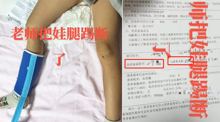 Nam sinh cấp cho 1 bị giáo viên tấn công gãy chân vì thế ko nghỉ ngơi trưa đích thị giờ.