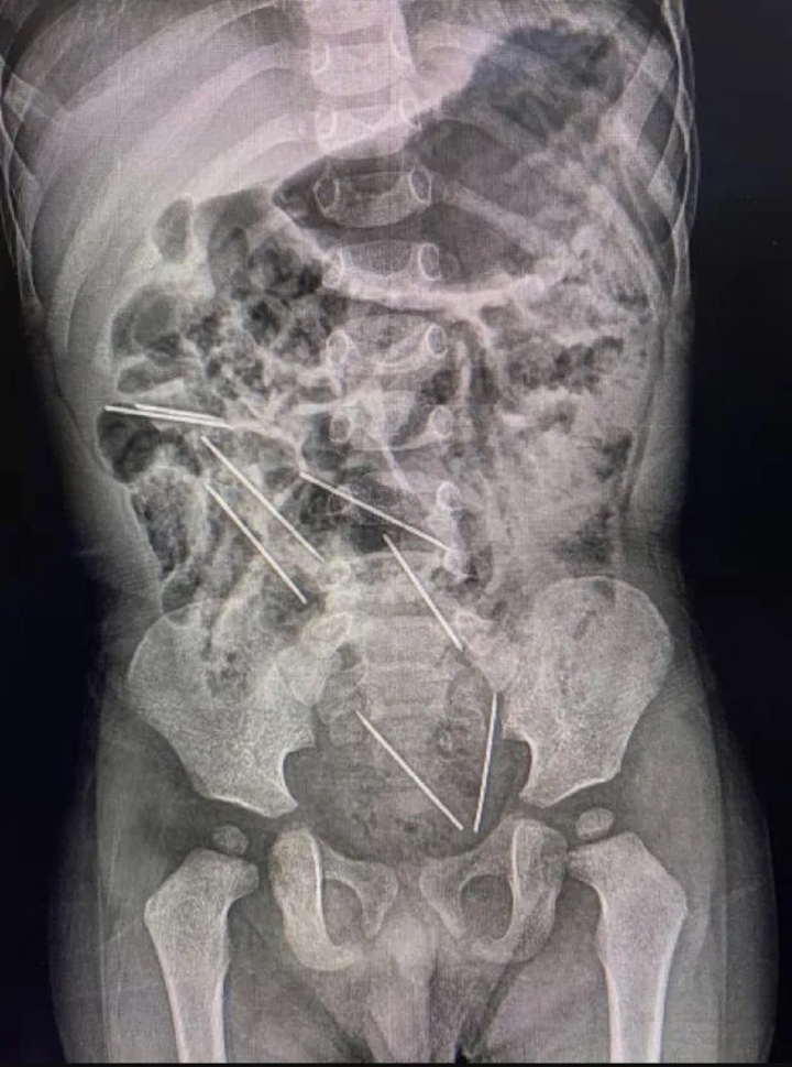 Kết ngược chụp X-quang đã cho chúng ta thấy sở hữu 8 cái kim vô bụng cậu bé xíu. (Ảnh: Jam Press)