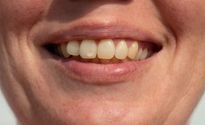 Vì sao răng với đốm trắng? Đó là tín hiệu sớm của việc bỏ khoáng bên dưới mặt phẳng men răng. (Ảnh: Colgate)