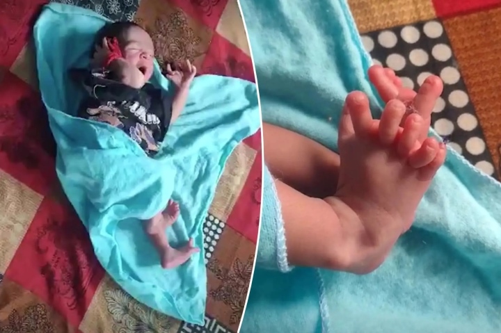 Em nhỏ bé sơ sinh ở đè Độ với 14 ngón tay, 12 ngón chân. (Ảnh: NYP)