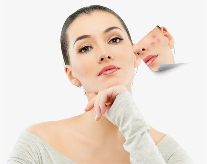 Hoạt chất trong dầu hướng dương còn có khả năng ứng chế vi khuẩn gây mụn trứng cá.