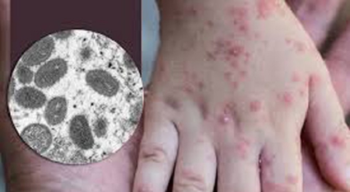 Đồng Nai ghi nhận ca đầu tiên mắc đậu mùa khỉ. (Ảnh: CDC Đồng Nai)