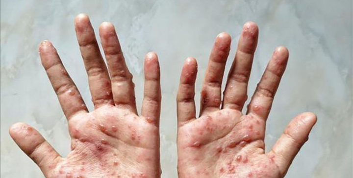 Đậu mùa khỉ là bệnh gây ra bởi virus Đậu mùa khỉ, là một thành viên của họ virus Đậu (Poxviridae).