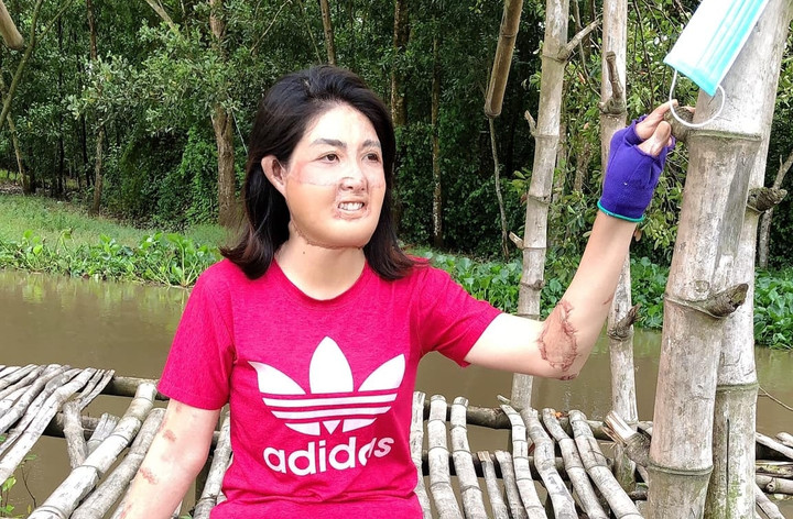 Sau 23 lần phẫu thuật, gương mặt Trang loang lổ, chằng chịt vết sẹo. (Ảnh: NVCC)