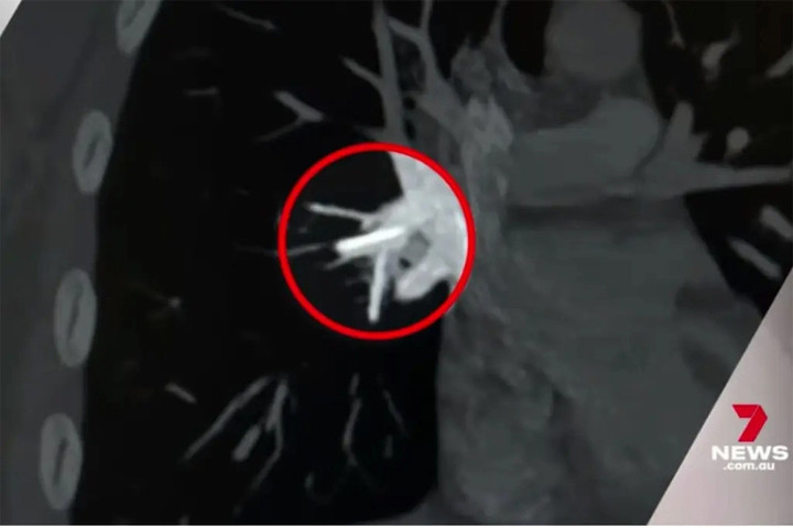 Các bác sĩ đã phát hiện ra điều này sau khi Cloe Westerway bắt đầu thấy tim đập nhanh hơn bình thường.