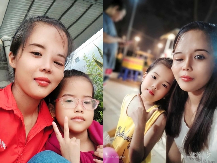 Khuôn mặt sau khi được loại bỏ khối u của chị Thuý. (Ảnh: NVCC)