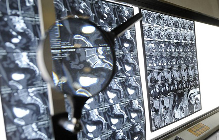 Phim chụp của một bệnh nhân ung thư. (Nguồn: TASS)