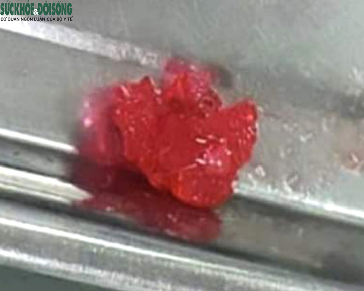 Dị vật cháu M. bị hóc là kẹo dẻo màu đỏ. (Ảnh: Đ.Tùy)